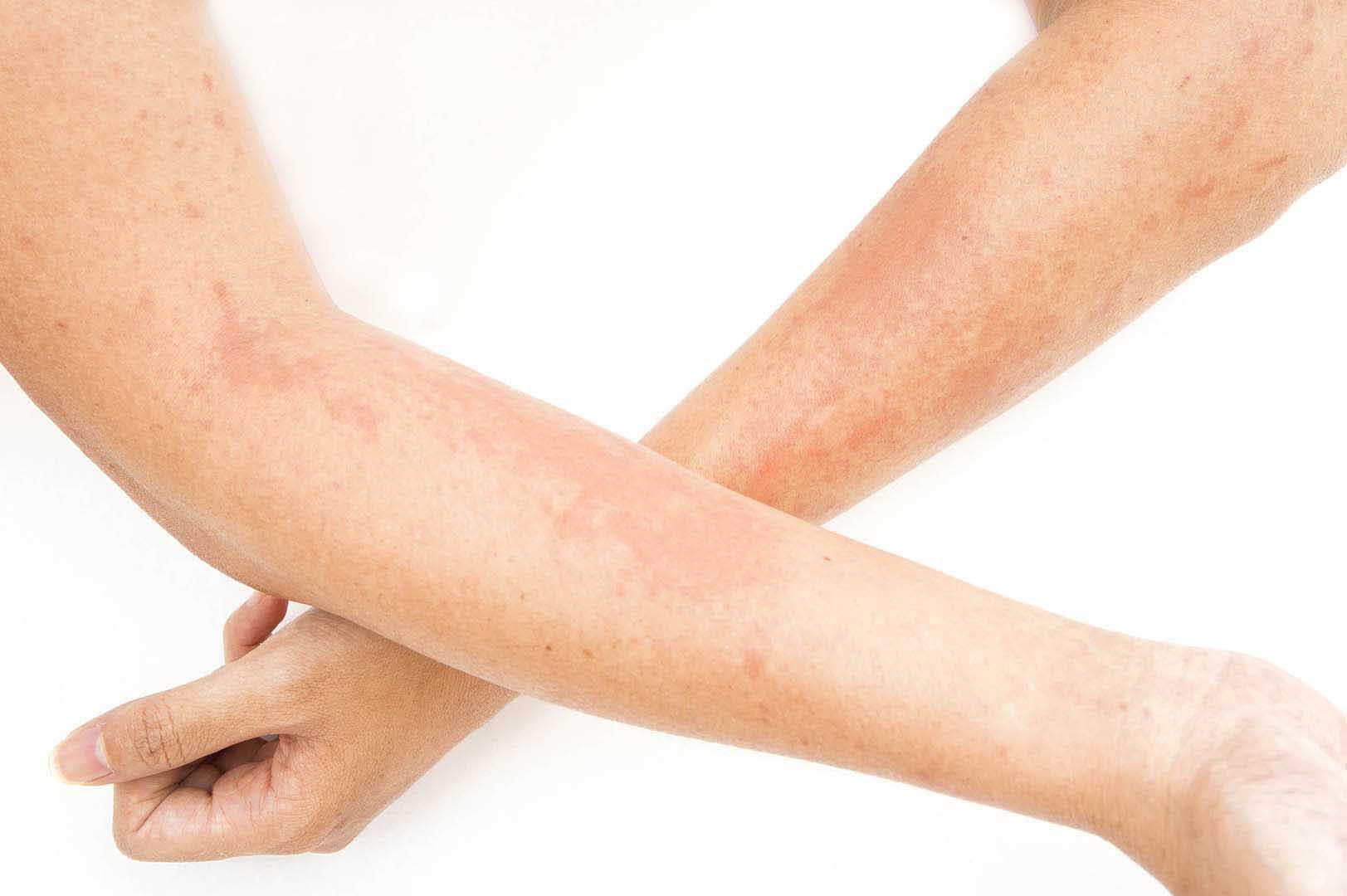 Dermatite Allergica Da Contatto X