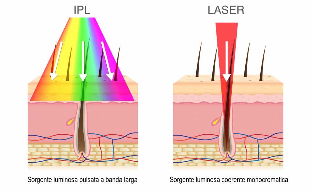 Laser Luce Pulsata