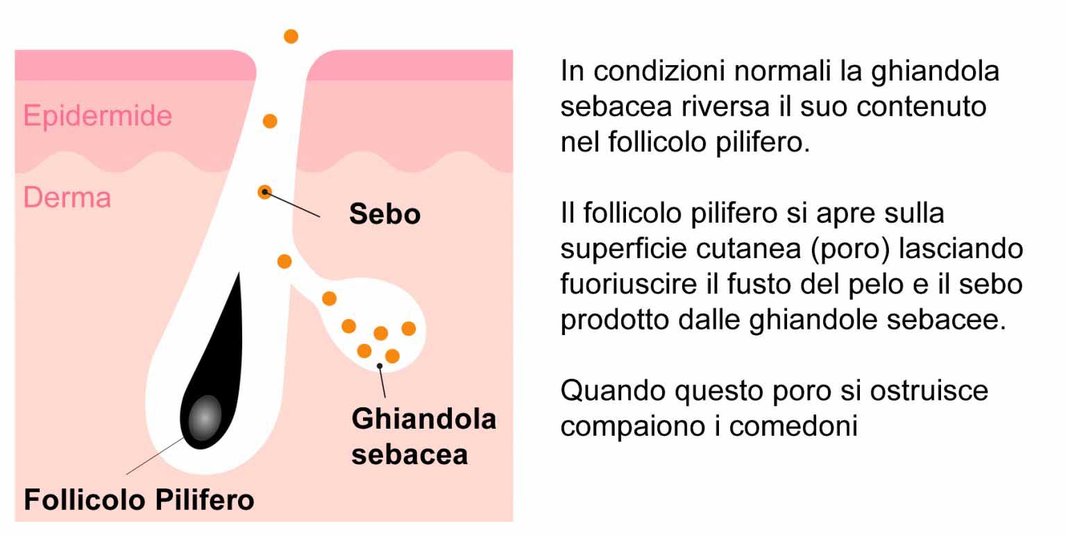 Punti Neri Cause e Trattamenti Efficaci X115®