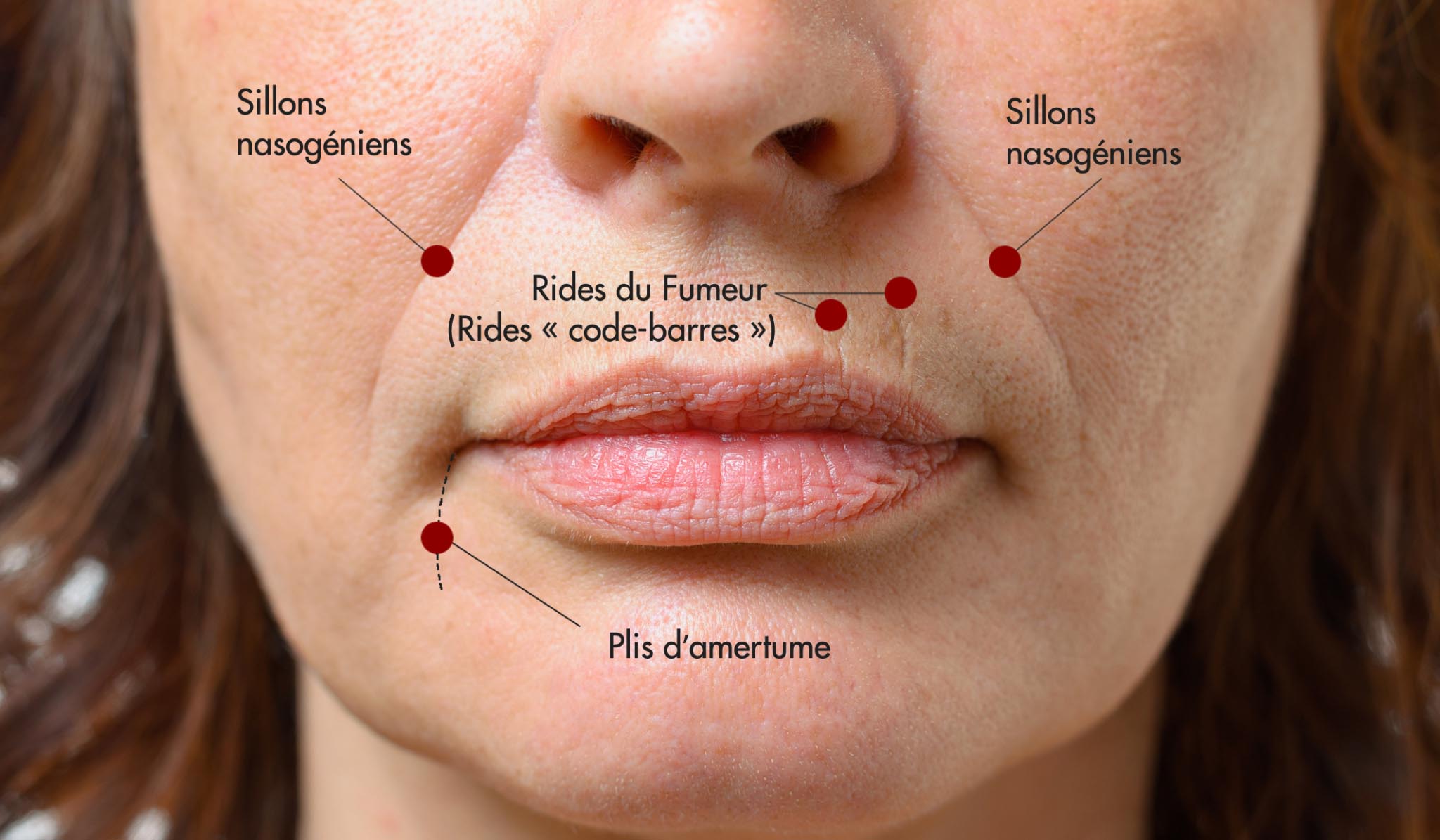 Acide hyaluronique Lèvres Filler Avantages, Prix, Risques X115®