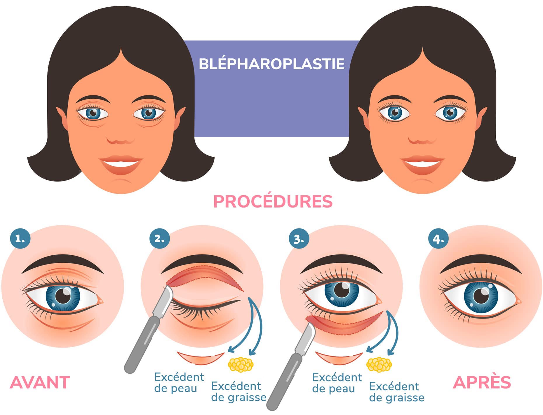 blepharoplastie