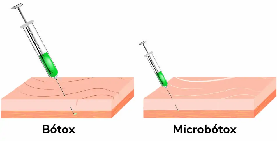 Botox y Microbotox
