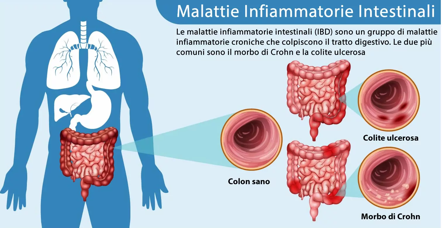 malattie infiammatorie intestinali