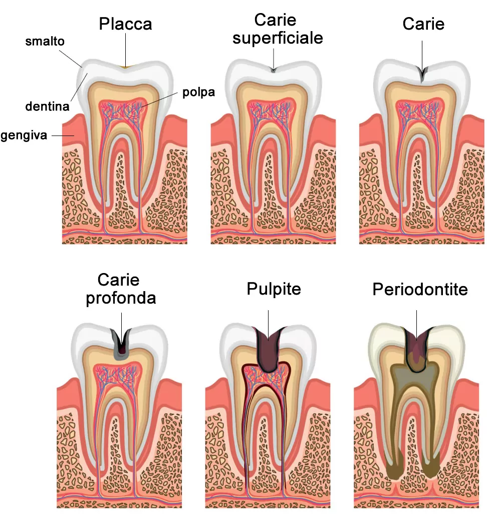 Denti anatomia e Carie